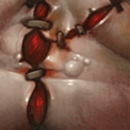 Flesh Heap - Pudge